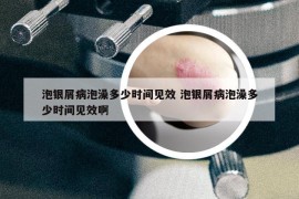 泡银屑病泡澡多少时间见效 泡银屑病泡澡多少时间见效啊