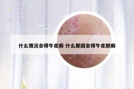 什么情况会得牛皮癣 什么原因会得牛皮肤癣