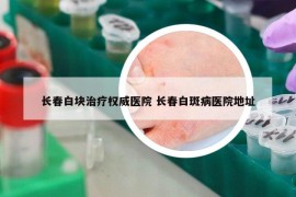 长春白块治疗权威医院 长春白斑病医院地址