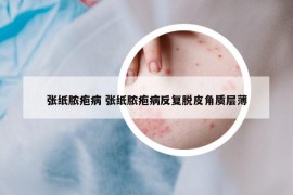 张纸脓疱病 张纸脓疱病反复脱皮角质层薄