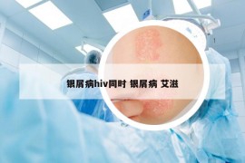 银屑病hiv同时 银屑病 艾滋