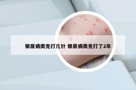 银屑病类克打几针 银屑病类克打了2年