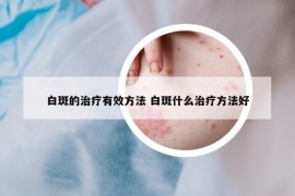 白斑的治疗有效方法 白斑什么治疗方法好