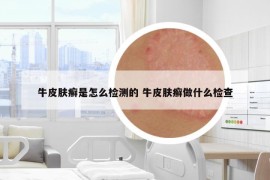 牛皮肤癣是怎么检测的 牛皮肤癣做什么检查