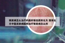 银屑病怎么治疗的最好推选西安北方 西安北方中医皮肤病医院治疗银屑病怎么样