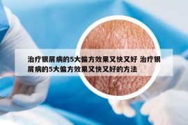 治疗银屑病的5大偏方效果又快又好 治疗银屑病的5大偏方效果又快又好的方法