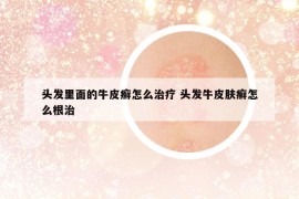 头发里面的牛皮癣怎么治疗 头发牛皮肤癣怎么根治