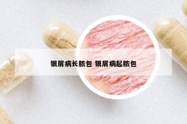 银屑病长脓包 银屑病起脓包