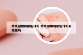 酵素副银屑病能抹吗 酵素副银屑病能抹吗有效果吗