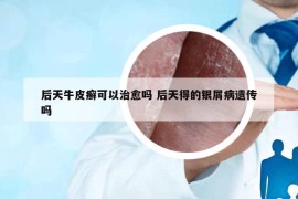 后天牛皮癣可以治愈吗 后天得的银屑病遗传吗