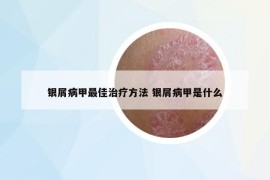 银屑病甲最佳治疗方法 银屑病甲是什么