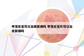 甲泼尼龙可以治银屑病吗 甲泼尼龙片可以治皮肤病吗