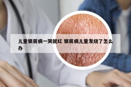 儿童银屑病一哭就红 银屑病儿童发烧了怎么办