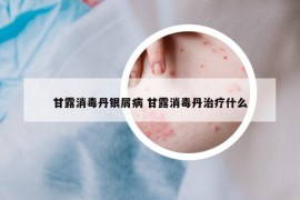 甘露消毒丹银屑病 甘露消毒丹治疗什么