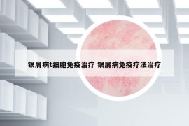 银屑病t细胞免疫治疗 银屑病免疫疗法治疗