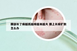 腰部长了癣越抓越痒越来越大 腰上长癣扩散怎么办