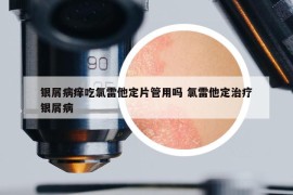 银屑病痒吃氯雷他定片管用吗 氯雷他定治疗银屑病