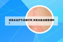 双氧水治疗牛皮癣行吗 双氧水能治银屑病吗?