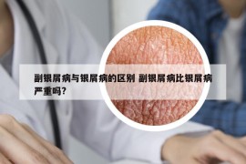 副银屑病与银屑病的区别 副银屑病比银屑病严重吗?