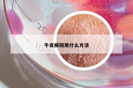 牛皮癣阳用什么方法