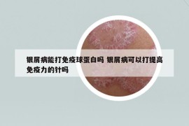 银屑病能打免疫球蛋白吗 银屑病可以打提高免疫力的针吗