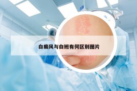 白癜风与白班有何区别图片