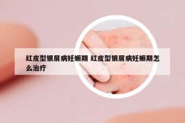 红皮型银屑病妊娠期 红皮型银屑病妊娠期怎么治疗