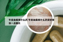 牛皮血癣用什么药 牛皮血癣用什么药膏好得快一点图片