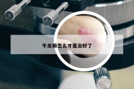 牛皮癣怎么才是治好了