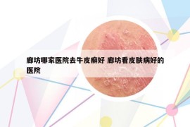 廊坊哪家医院去牛皮癣好 廊坊看皮肤病好的医院