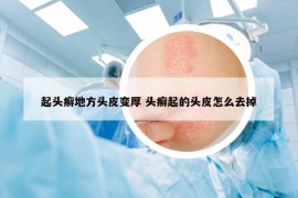 起头癣地方头皮变厚 头癣起的头皮怎么去掉