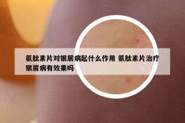 氨肽素片对银屑病起什么作用 氨肽素片治疗银屑病有效果吗