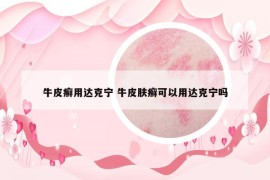 牛皮癣用达克宁 牛皮肤癣可以用达克宁吗