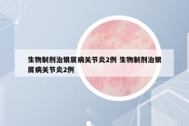 生物制剂治银屑病关节炎2例 生物制剂治银屑病关节炎2例