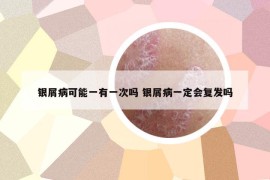 银屑病可能一有一次吗 银屑病一定会复发吗