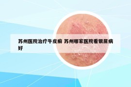 苏州医院治疗牛皮癣 苏州哪家医院看银屑病好