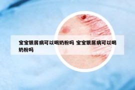 宝宝银屑病可以喝奶粉吗 宝宝银屑病可以喝奶粉吗