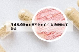 牛皮肤癣什么东西不能吃的 牛皮肤癣哪些不能吃