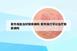 紫外线能治好银屑病吗 紫外线灯可以治疗银屑病吗