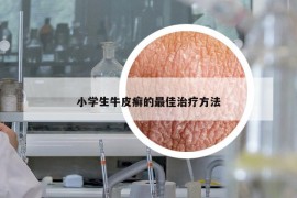 小学生牛皮癣的最佳治疗方法