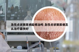 急性点状银屑病能根治吗 急性点状银屑病怎么治疗最快好