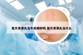 复方青黛丸治牛皮癣好吗 复方青黛丸治什么