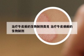 治疗牛皮癣的生物制剂类克 治疗牛皮病癣的生物制剂