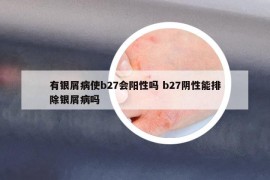 有银屑病使b27会阳性吗 b27阴性能排除银屑病吗