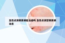 急性点滴银屑病能治逾吗 急性点滴型银屑病治愈