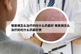 银屑病怎么治疗的吃什么药最好 银屑病怎么治疗的吃什么药最好使