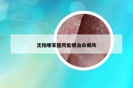 沈阳哪家医院能根治白癜风