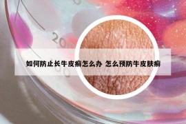 如何防止长牛皮癣怎么办 怎么预防牛皮肤癣