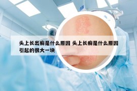 头上长出癣是什么原因 头上长癣是什么原因引起的很大一块