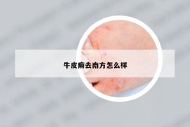 牛皮癣去南方怎么样